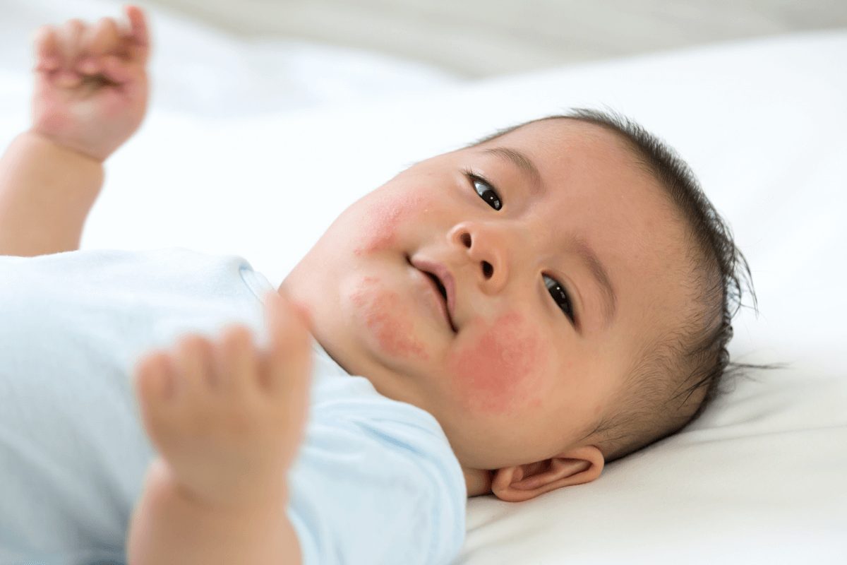 Allergy Basics